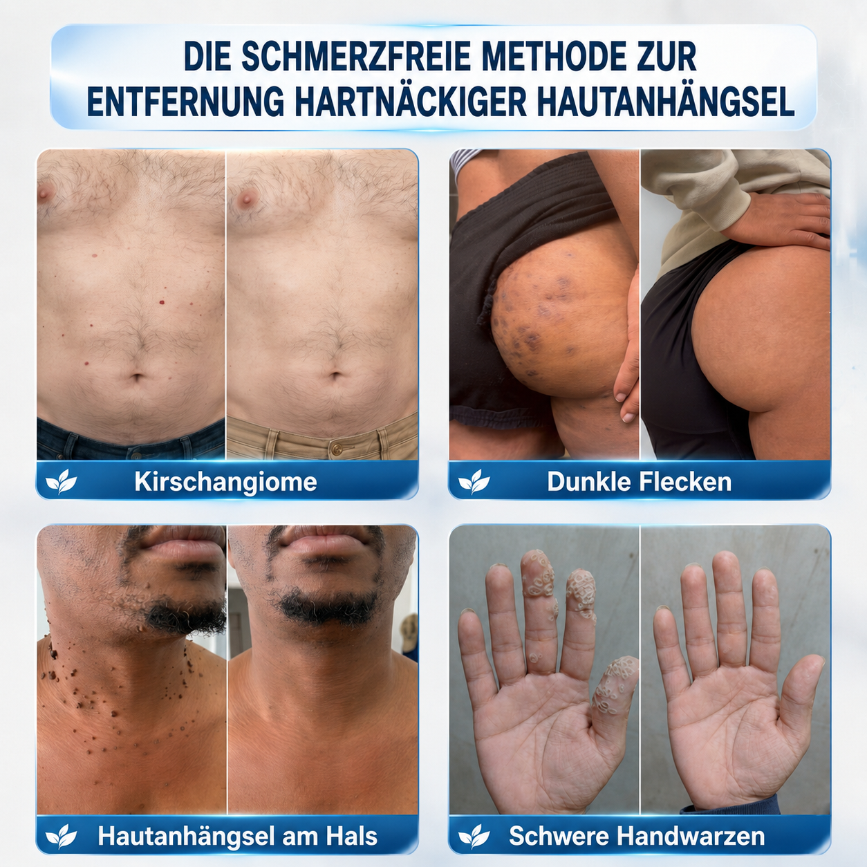 💧💧𝑶𝒇𝒇𝒊𝒛𝒊𝒆𝒍𝒍𝒆𝒓 𝑺𝒕𝒐𝒓𝒆 | 𝑵𝐞𝒌𝐢𝐬𝐬® 🌿 𝑴𝒊𝒌𝒓𝒐𝒏𝒂𝒅𝒆𝒍𝒏 𝑴𝒂𝒌𝒆𝒍𝒍𝒐𝒔𝒆 𝑯𝒂𝒖𝒕 𝑯𝒂𝒖𝒕 𝑾𝒂𝒓𝒛𝒆 𝑬𝒏𝒕𝒇𝒆𝒓𝒏𝒖𝒏𝒈 𝑷𝒇𝒍𝒂𝒔𝒕𝒆𝒓 (𝐹ü𝑟 𝐻𝑎𝑢𝑡𝑎𝑛ℎä𝑛𝑔𝑠𝑒𝑙, 𝑘𝑙𝑒𝑖𝑛𝑒 𝐻𝑎𝑢𝑡𝑤𝑢𝑐ℎ𝑒𝑟𝑢𝑛𝑔𝑒𝑛, 𝑊𝑎𝑟𝑧𝑒𝑛, 𝑀𝑢𝑡𝑡𝑒𝑟𝑚𝑎𝑙𝑒, 𝐴𝑙𝑡𝑒𝑟𝑠𝑓𝑙𝑒𝑐𝑘𝑒𝑛 𝑢𝑛𝑑 𝑃𝑖𝑔𝑚𝑒𝑛𝑡𝑠𝑡ö𝑟𝑢𝑛𝑔𝑒𝑛.)